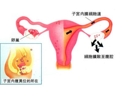 引起子宫内膜异位症的原因有哪些